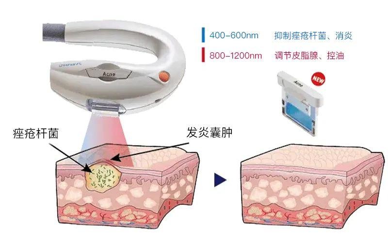 Acne痤瘡濾光片